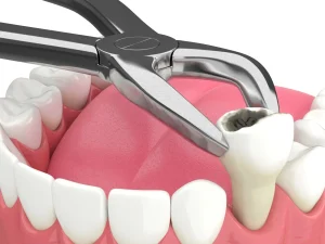teeth extraction